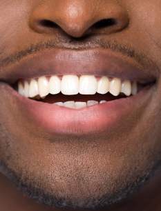Teeth Whitening